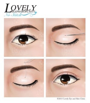 Which look of double eyelid suitable for you?
